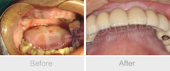 大连做半口种植牙要多少钱? 大连做半口种植牙要多少钱?